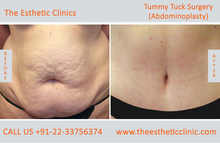 Tummy Tuck Surgery, Abdominoplasty before after photos in mumbai india (4)